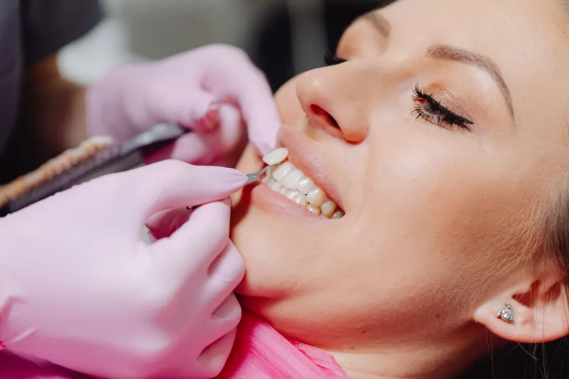 Odontóloga colocando una carilla dental durante un tratamiento estético